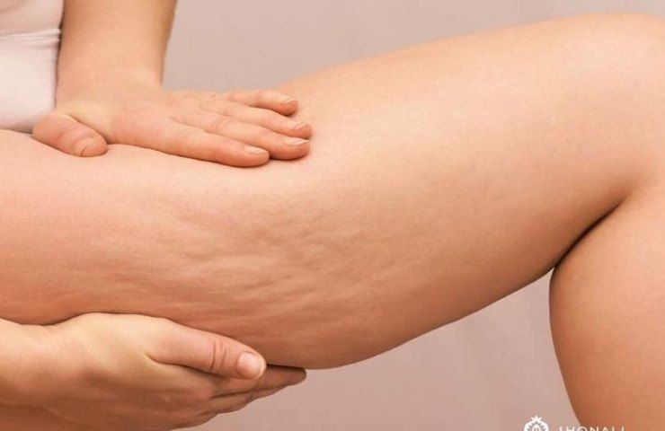 Cellulite come combatterla