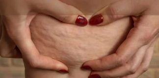 Cellulite come combatterla