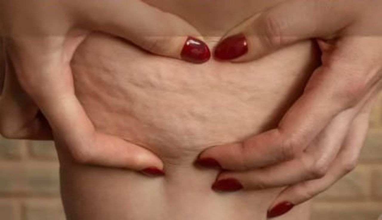 Cellulite come combatterla